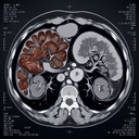 МРТ селезінки