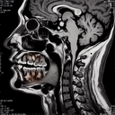 МРТ скронево-нижньощелепного суглоба