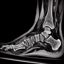 МРТ гомілково-ступневогу суглобу