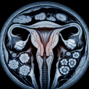 МРТ матки шийки матки